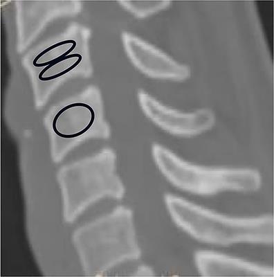 Hounsfield Unit for Assessing Bone Mineral Density Distribution Within Cervical Vertebrae and Its Correlation With the Intervertebral Disc Degeneration